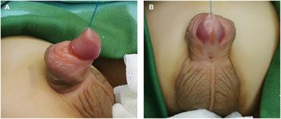 Grafts vs. flaps: a comparative study of Bracka repair and staged transverse preputial island flap urethroplasty for proximal hypospadias with severe ventral curvature